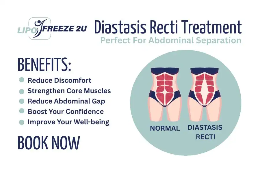 Benefits of body toning treatment Kent for Diastasis recti
