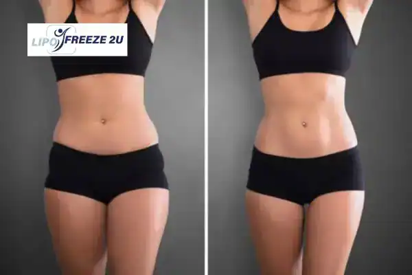How Can LIPO FREEZE 2U Support Your Post-Pregnancy Body Recovery Kent?