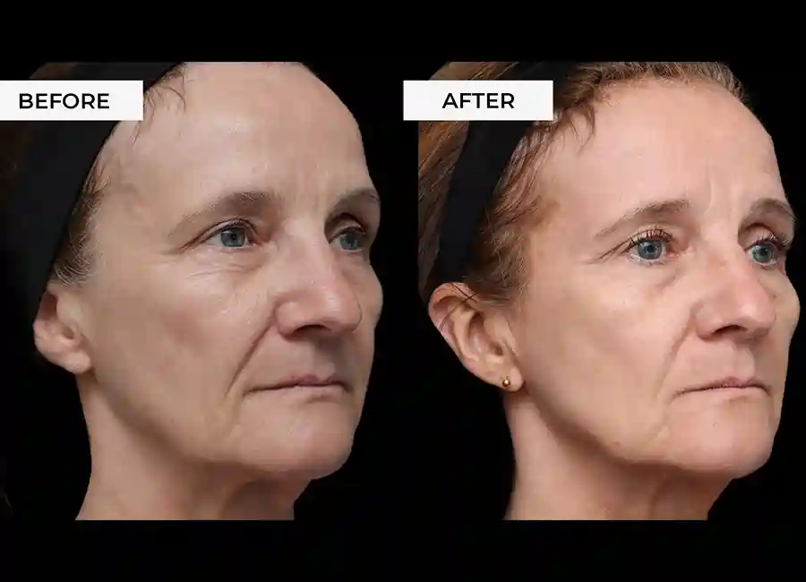 How Many RF Microneedling Sessions Will You Need to See a Difference Kent?