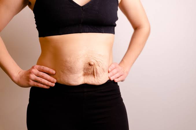 Is Surgery Really the Only Way to Repair Diastasis Recti Kent?