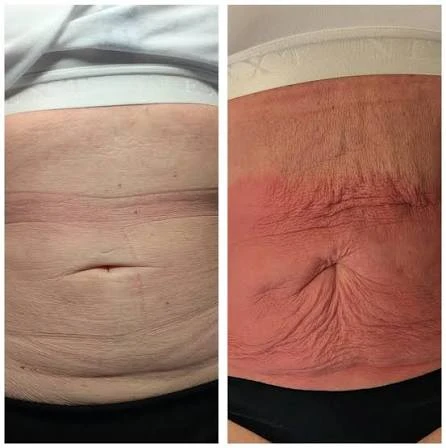 How Does RF Microneedling Improve Crepey, Thin and Uneven Skin Texture Kent?