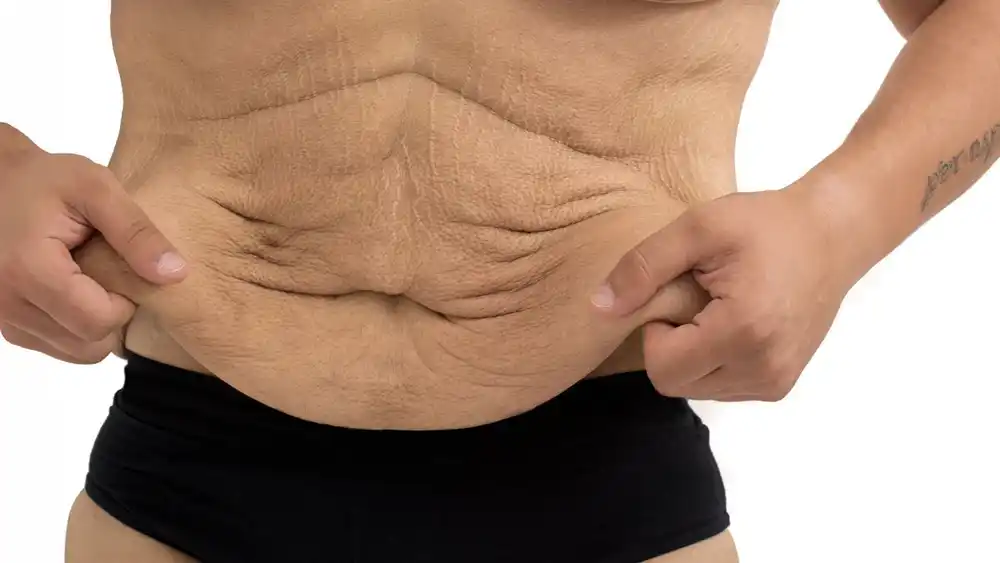Why Does Weight Loss Medication Leave Some People With Loose or Sagging Skin Kent?